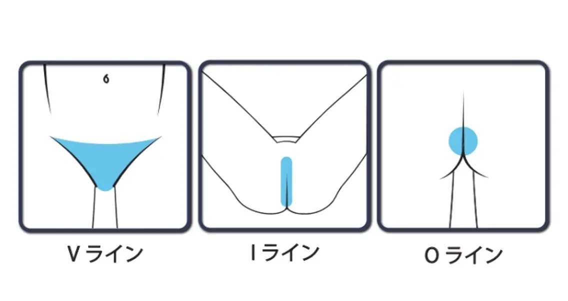 VIO脱毛の写真