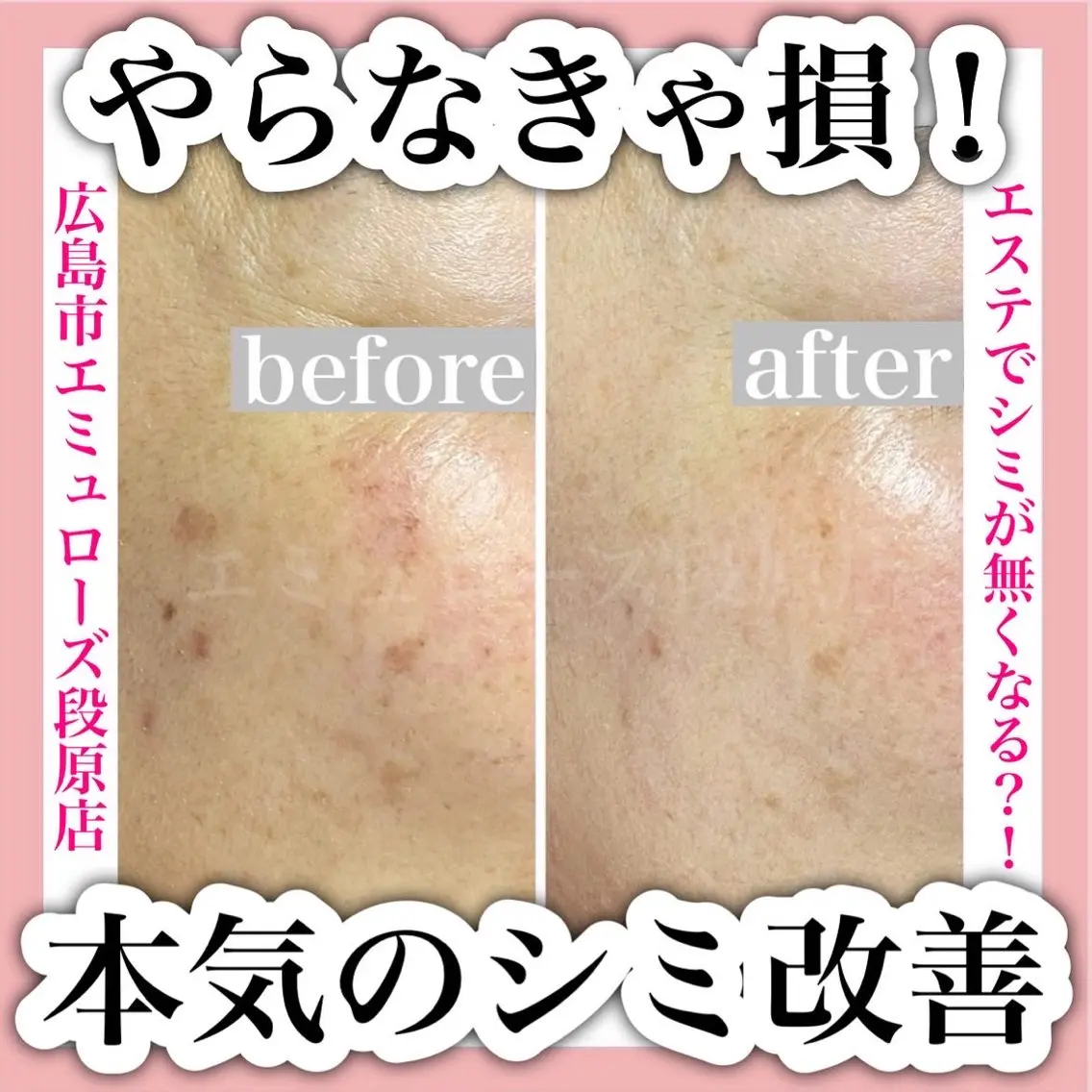 当店人気No. 1《光打ち放題》シミ・くすみ・ニキビなど肌悩み全解消！の写真