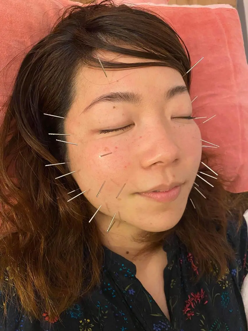 やさしい美容鍼＋全身調整（90分）― リラックスしながら整えるケアコース ―の写真