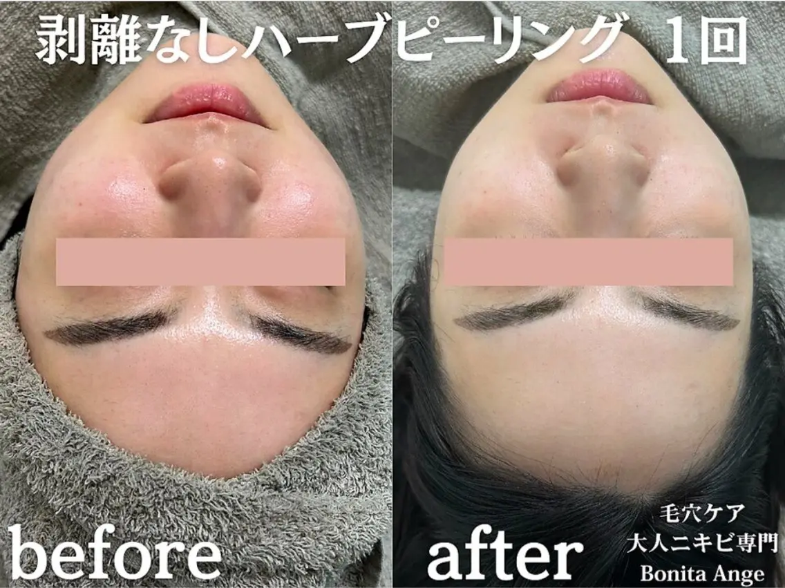 【症例撮影モデル募集｜残3名様】剥離なし🌿オーダーメイドハーブピーリング《毛穴・くすみ・肌荒れでお悩みの20​〜​30代》の写真