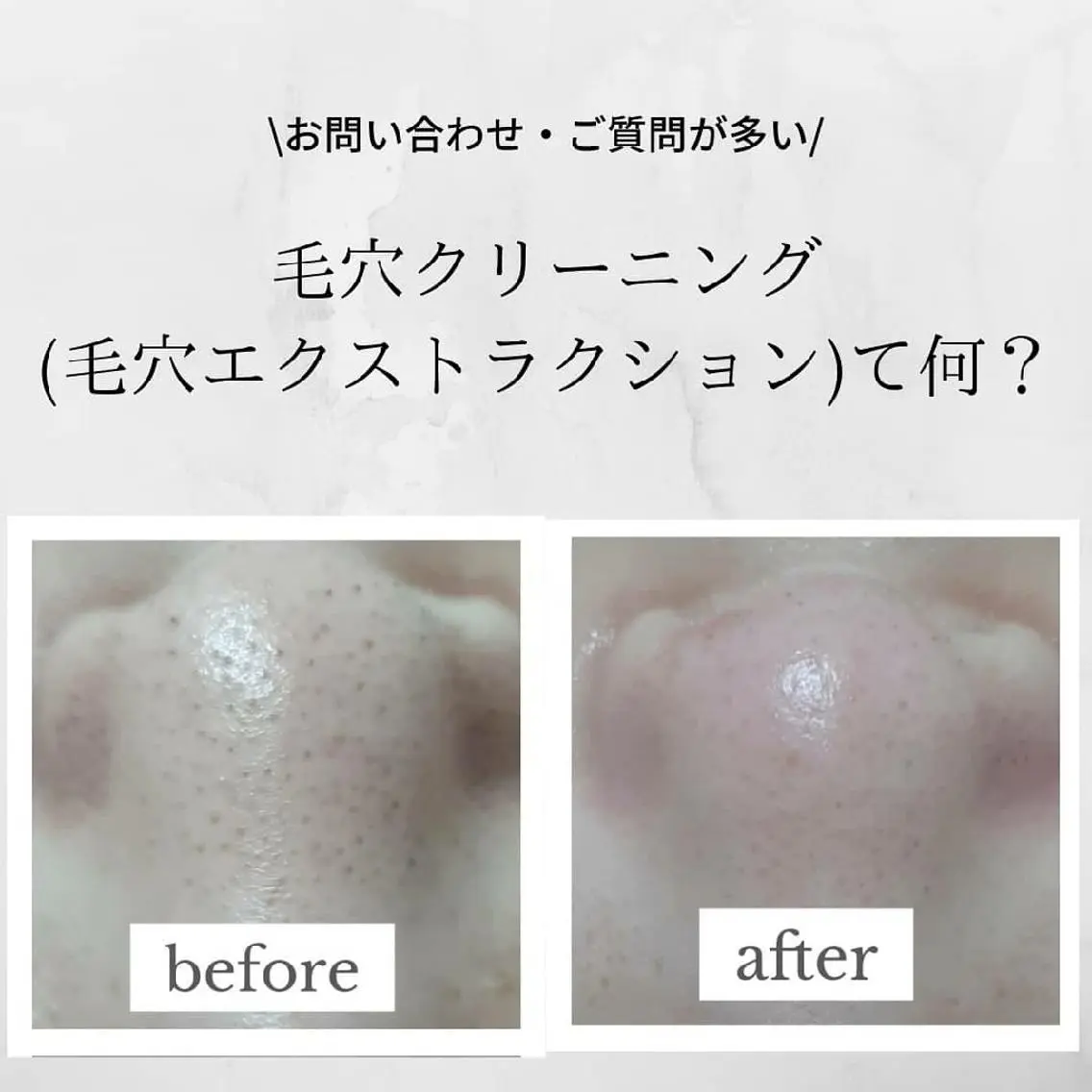 学生様限定✨黒ずみ・詰まり毛穴クリーニングエステの写真
