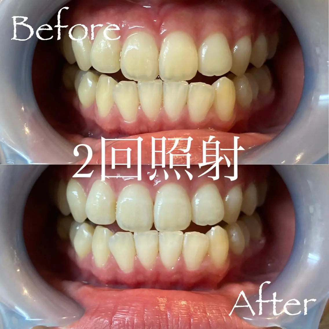 その他 LBSホワイトニング 新宿店💎公式のエステ・リラクイメージ