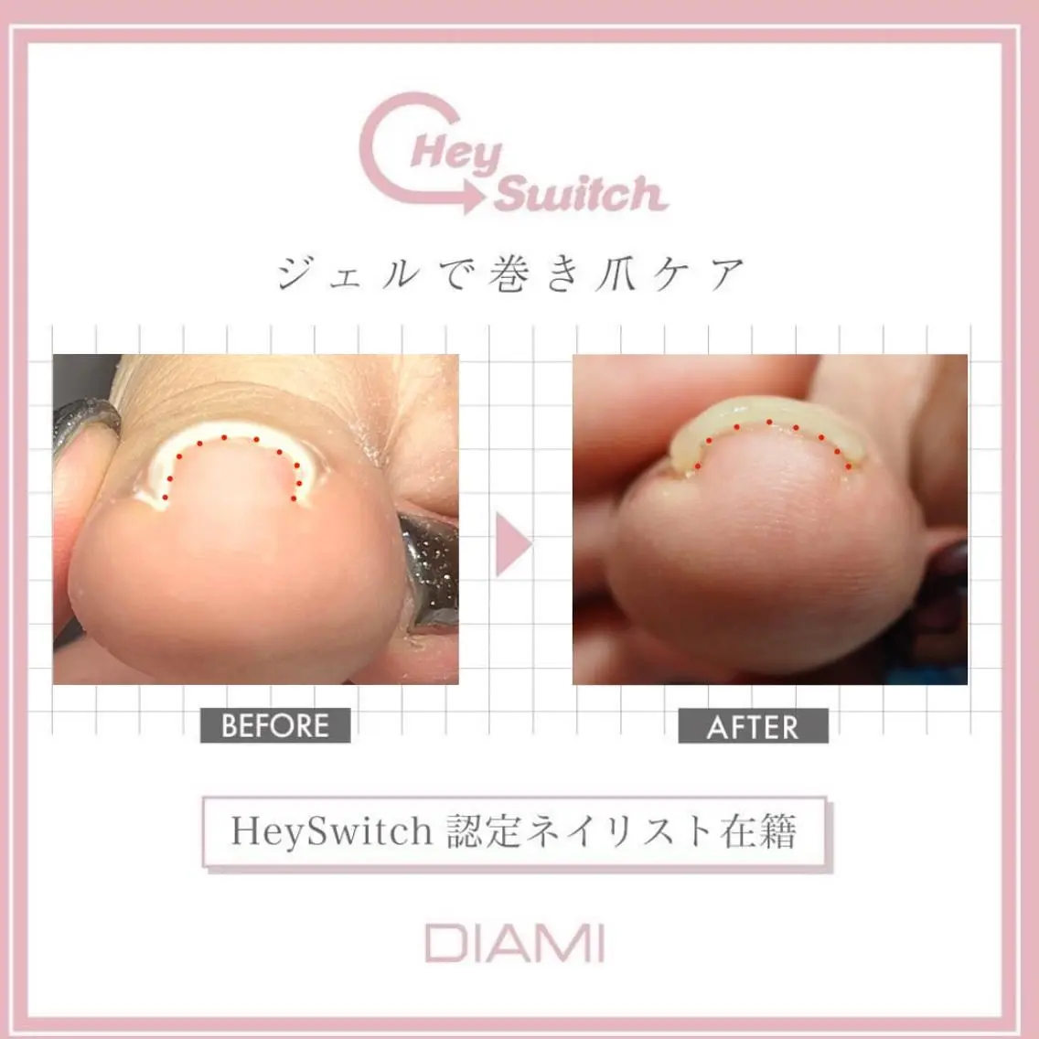 【特殊ジェルで行う巻き爪ケア】2回目まで両親指半額の¥5500！(最低でも4回の施術がおすすめです)の写真