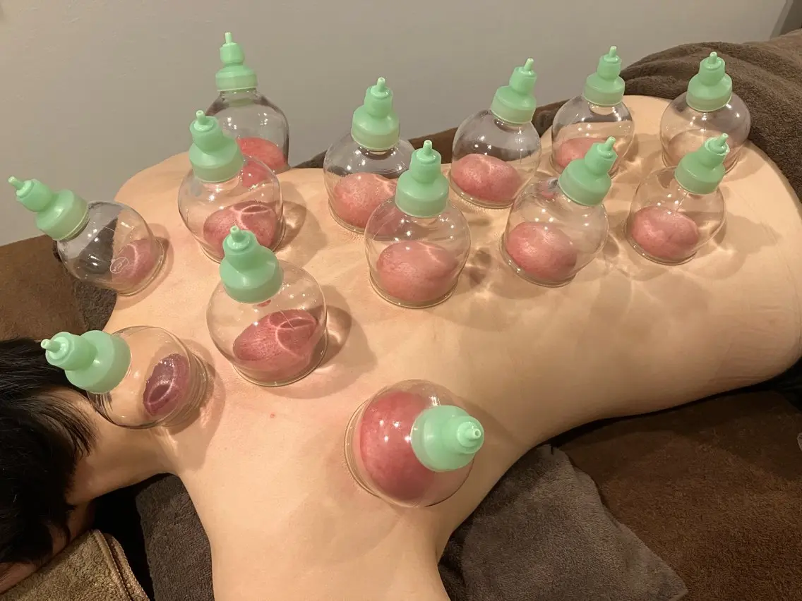 カッピング(吸い玉)orスライドカッピングの写真