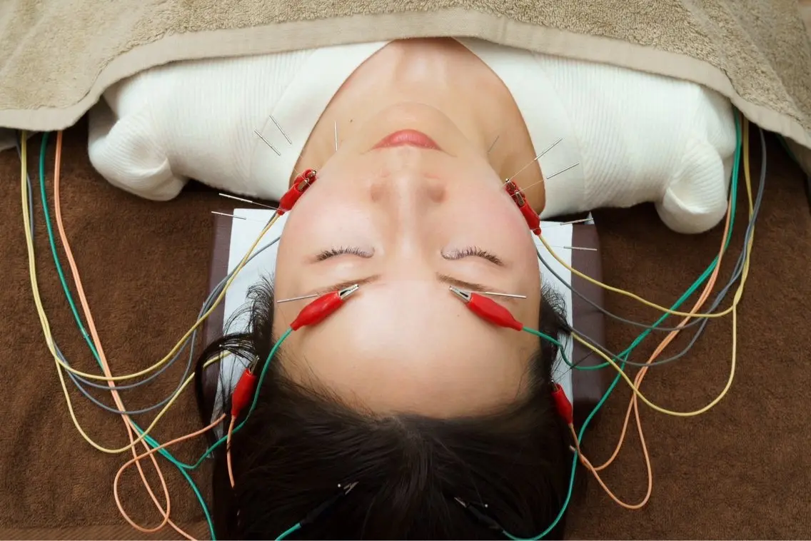 超お得!!【女性限定】電気を流す美容鍼🪡の写真