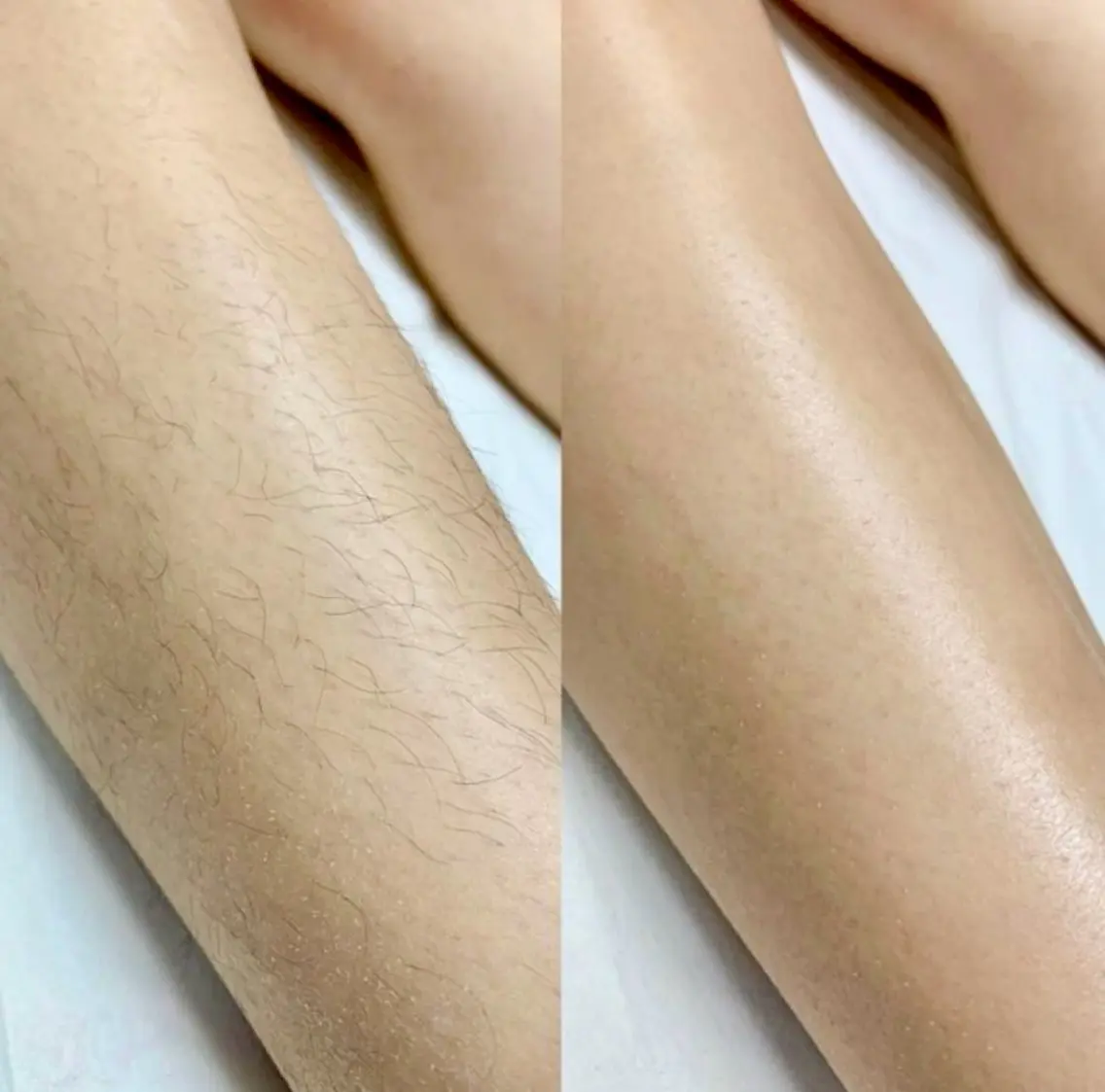 脚トータルWAX脱毛の写真