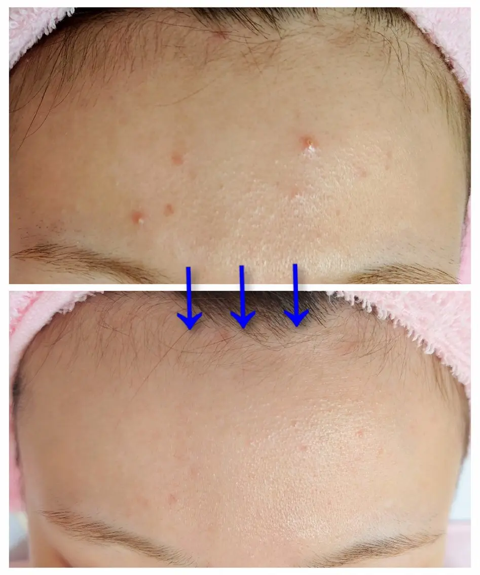 【ツルツル✨ピーリングケア】ニキビ、毛穴ザラつき、ツルツル水光肌へ✨化粧のりも良く♪素肌美人へ☆【約55〜60分】の写真