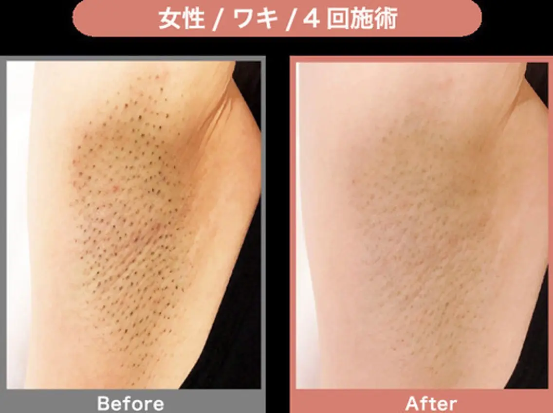 *ワンコイン!美肌(脱毛➕フォトフラッシュ)脱毛 脇の写真