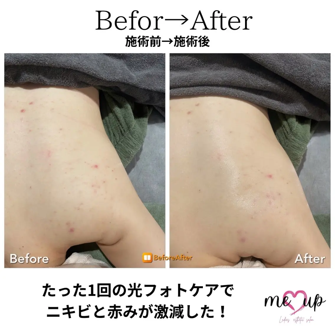 エステ Meupニキビ専門店 背中/ハーブ/肌管理のその他イメージ