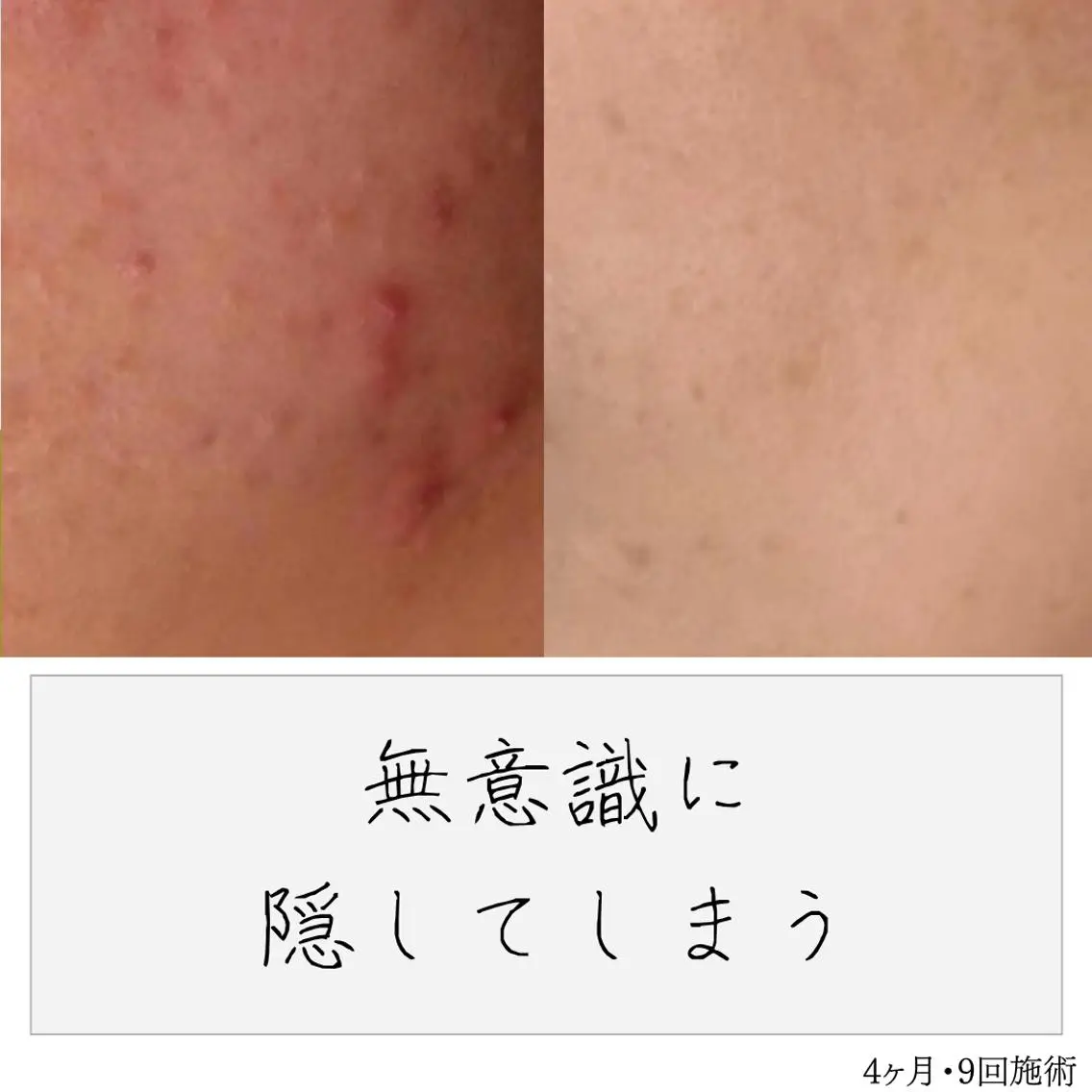 ニキビ経験者が施術 する専門サロン🌻のエステ・リラクイメージ