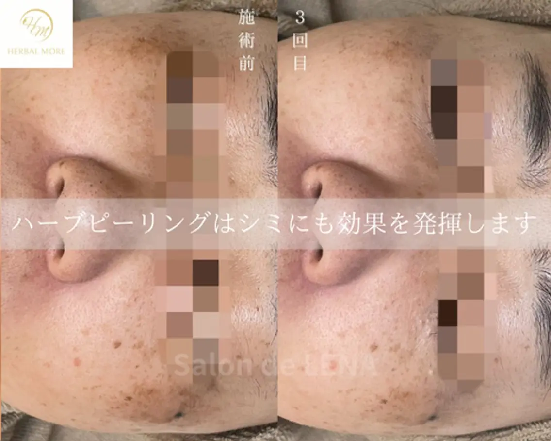 エステ ハーブピーリング専門 サロンドレナ平岡のエステ・リラクイメージ