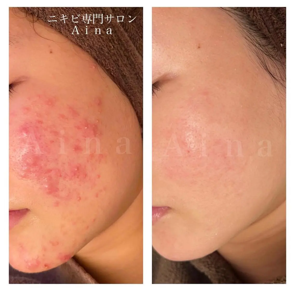 セミロング パーマ ヘアアレンジ メンズ キッズ ネイル マツエク・マツパ アイブロウ エステ リラク ニキビ跡専門サロン Ａｉｎａのエステ・リラクイメージ