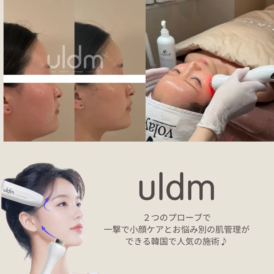 人気No.3🎯一撃小顔リフト💖韓国最新機器ULDM✖️白玉肌管理✖️小顔コルギ 90分/たるみ、エラ、ほうれい線の写真