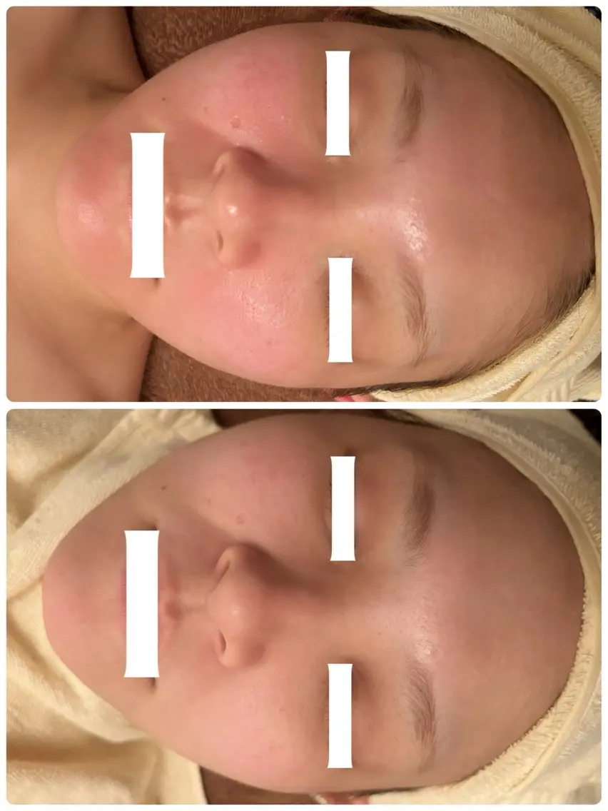 【小顔✖️美白🤍🫧】保湿小顔マッサージ💆🏼‍♀️水素パック🫧デコルテ，首ヘッドのマッサージ付き🌿の写真