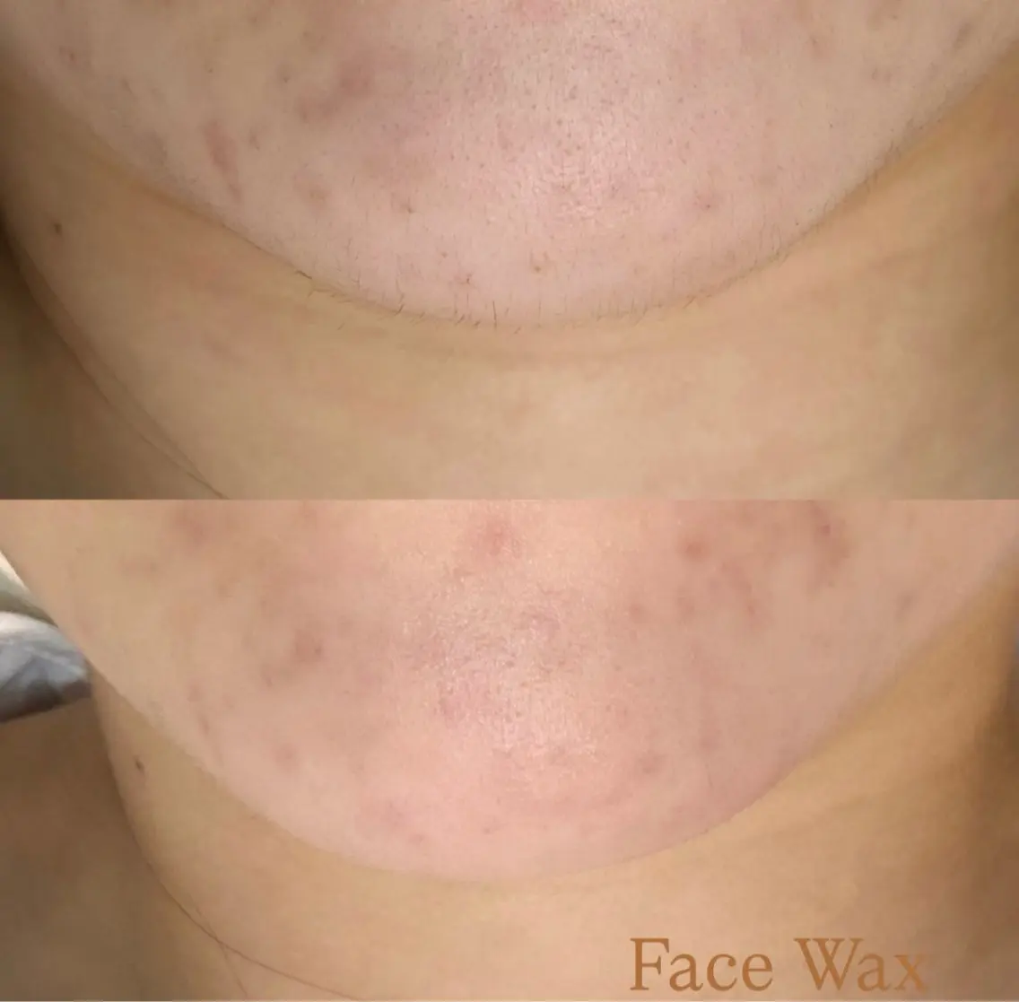 つるん肌💎透明感UPフェイスWAX＋光脱毛の写真