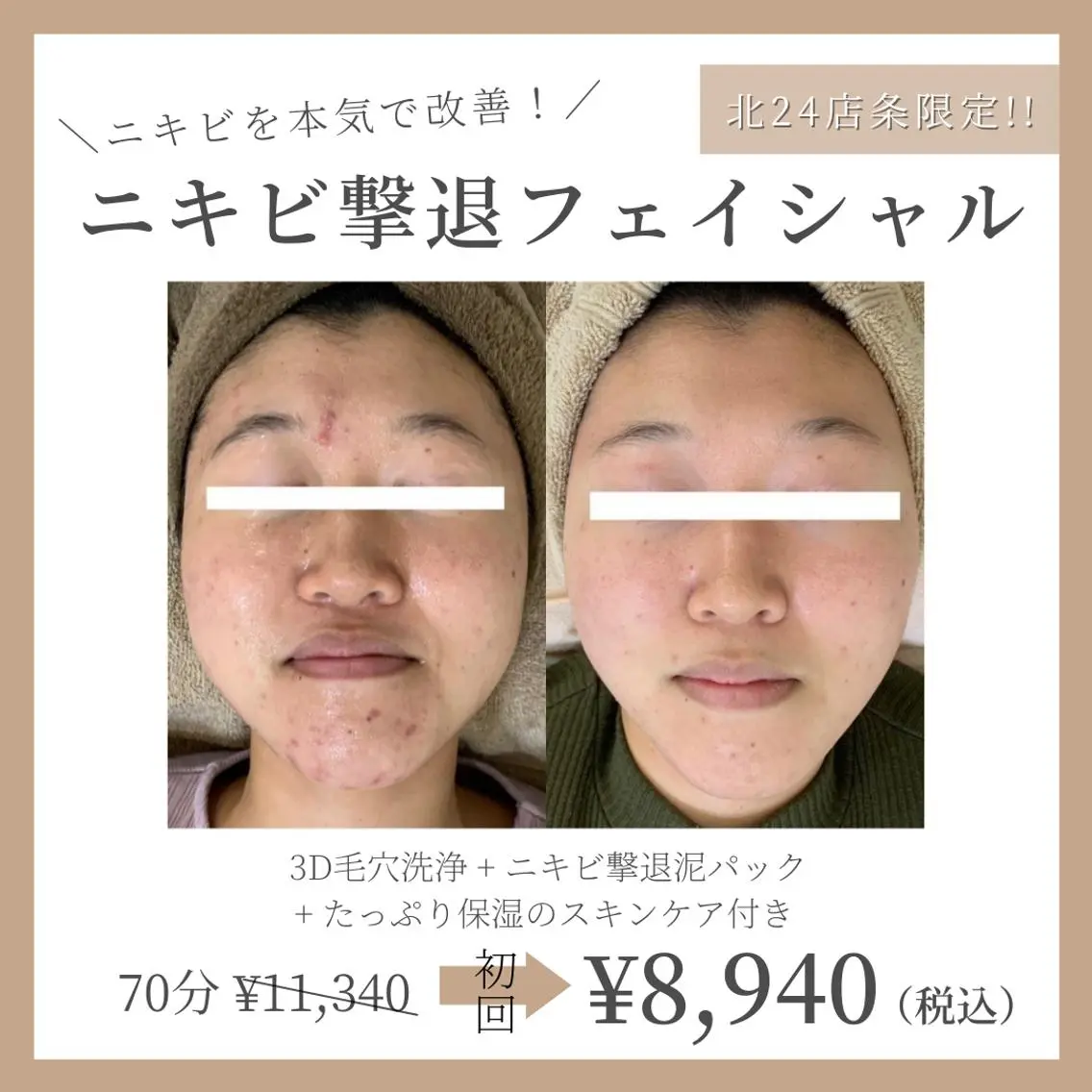 【本気で改善!】ニキビ撃退泥パックフェイシャル 約70分(カウンセリング+3D毛穴洗浄+泥パック+高保湿スキンケア)の写真