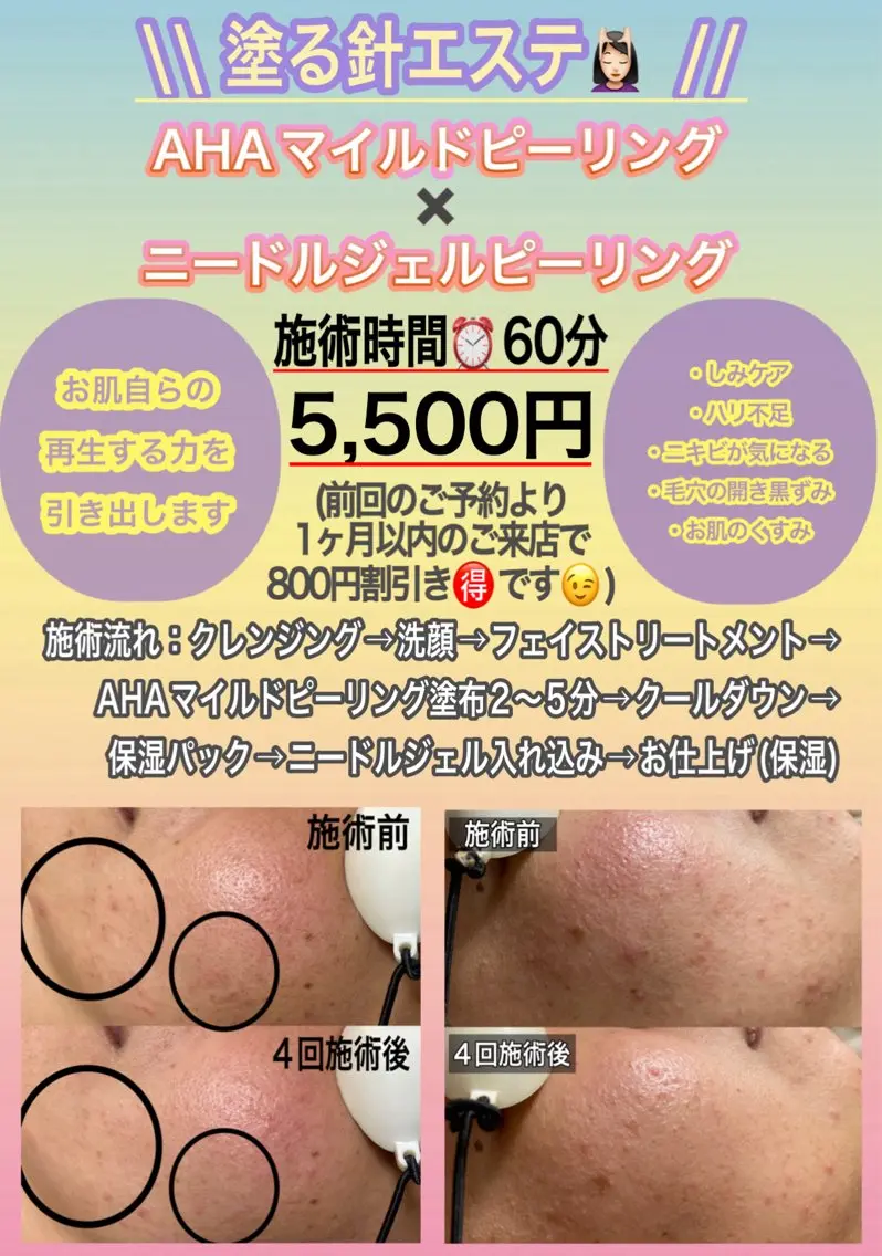 新メニュー🆕【塗る針エステ60分】今話題のスピキュールやCICA配合ジェル使用🫧の写真