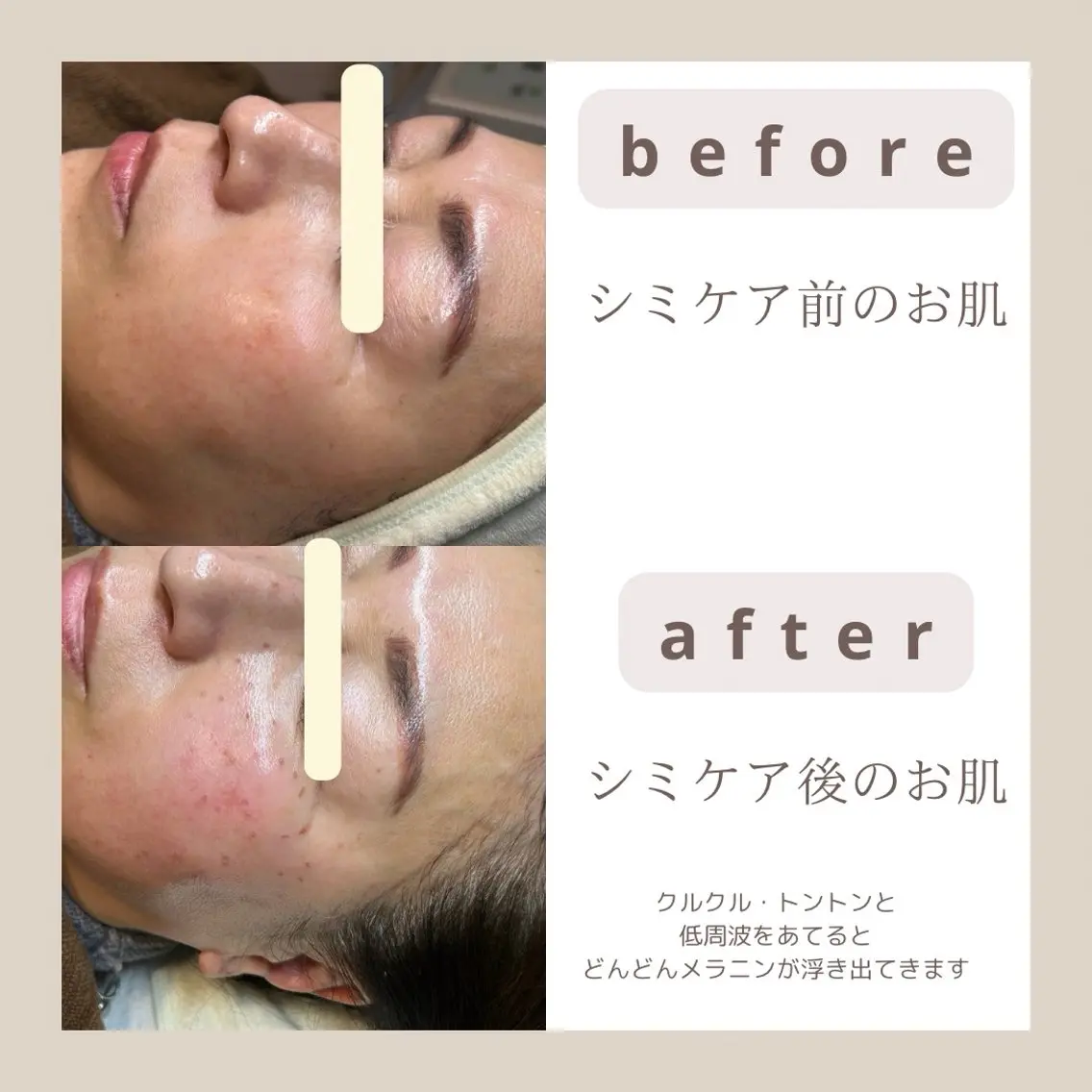 【basicシミケアコース】の写真