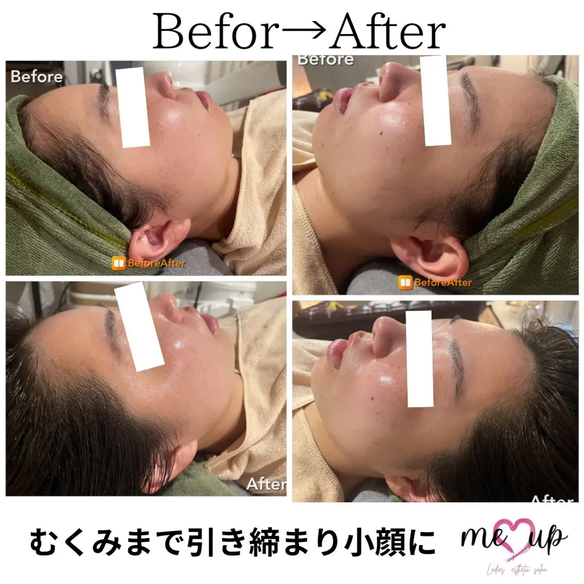 エステ Meupニキビ専門店 背中/ハーブ/肌管理のその他イメージ