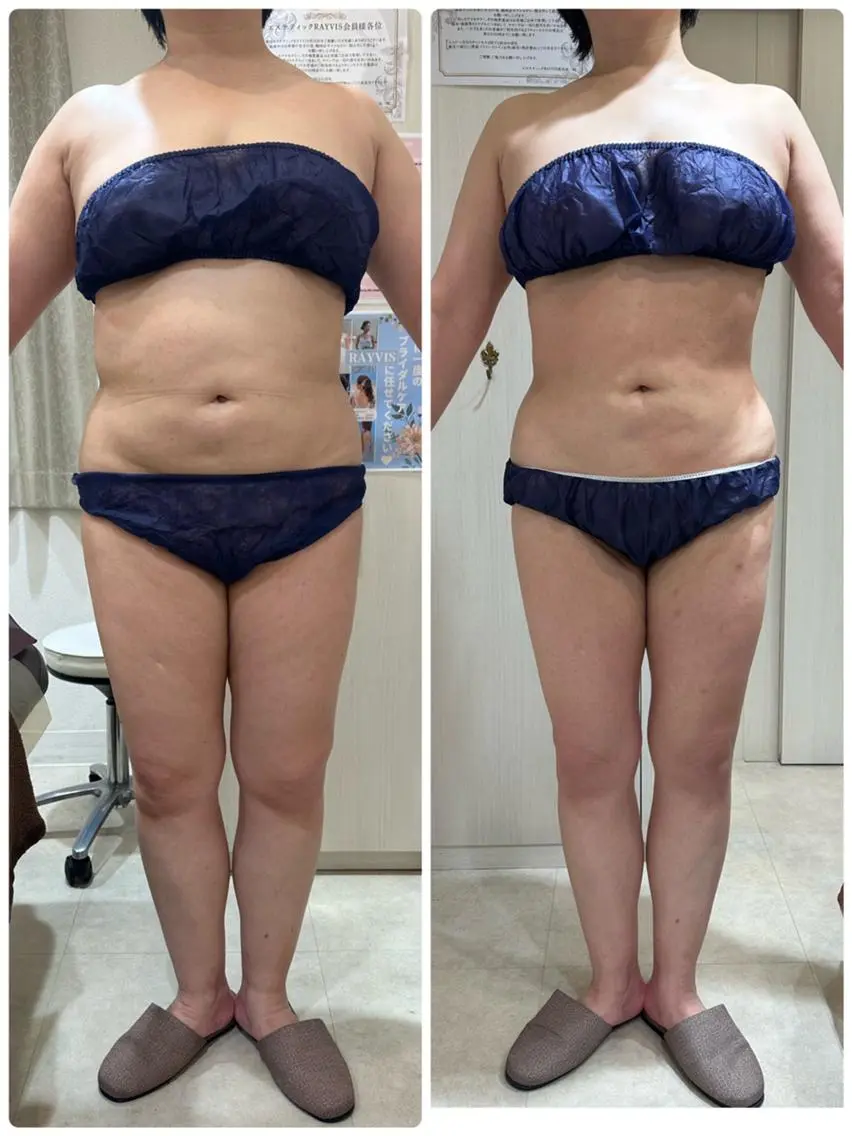 くびれが欲しい、下っ腹をスッキリさせたい！そんなあなたにオススメ‼️セルライト吸引でスッキリお腹に✨の写真