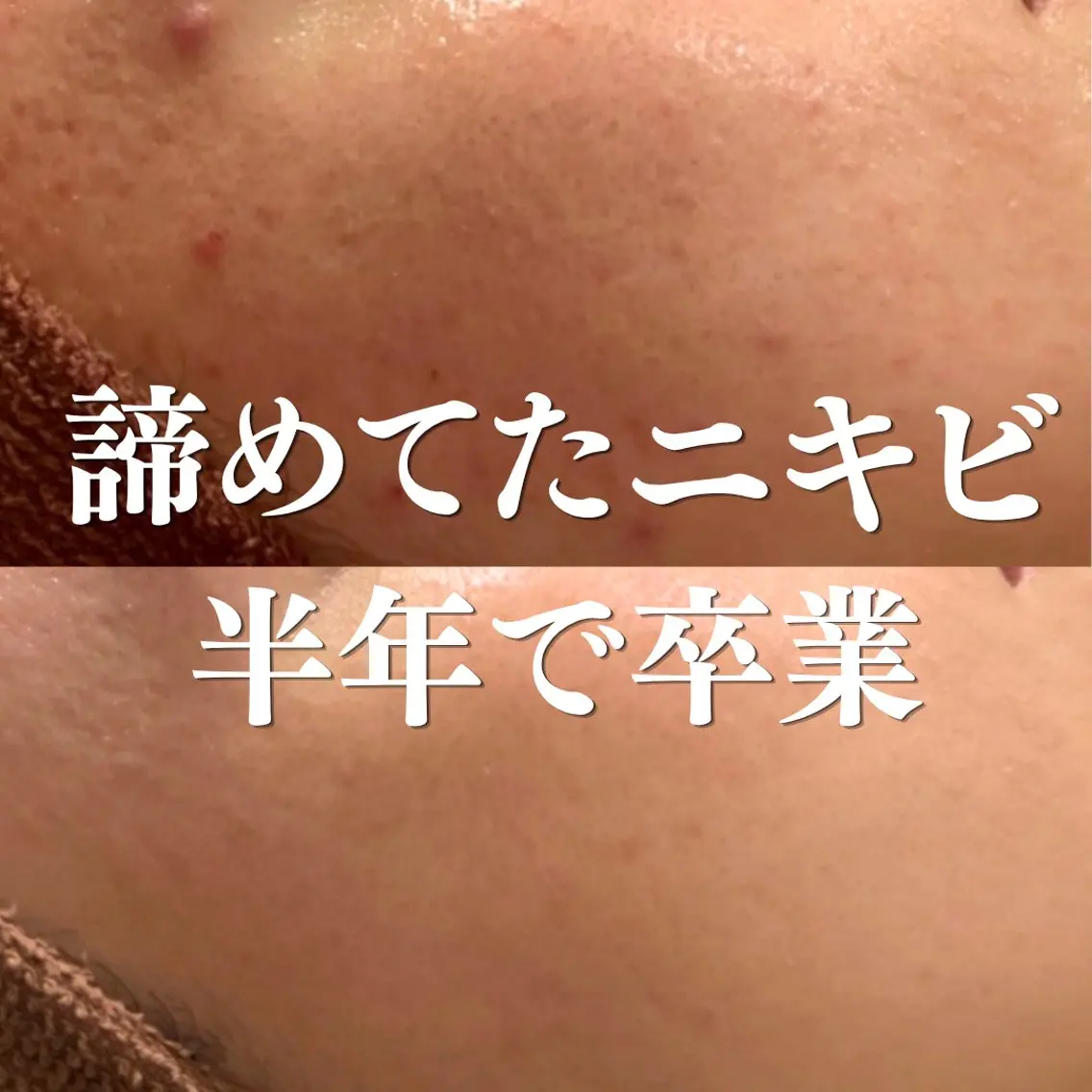ニキビ特化型エステ 🍋最短で肌質改善のエステ・リラクイメージ