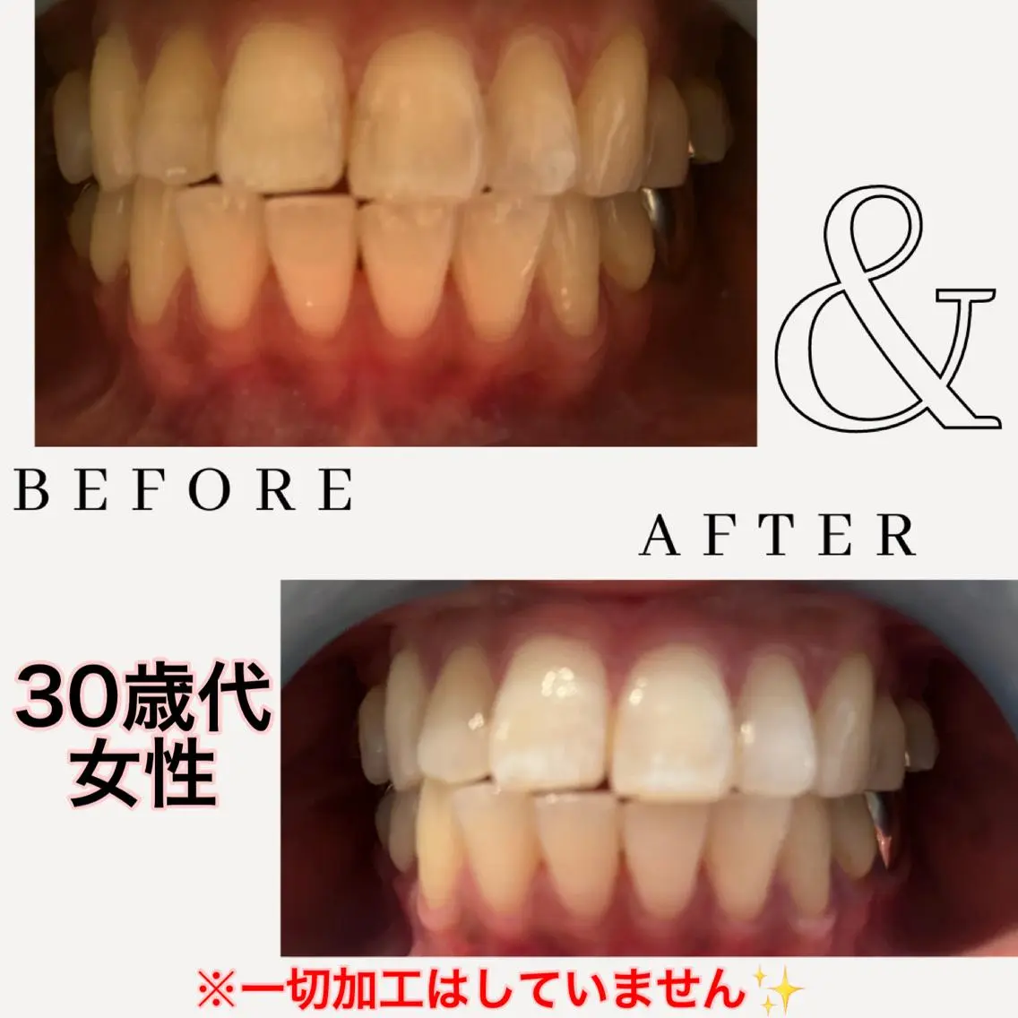 🦷セルフホワイトニング🦷白い歯へ!虫歯予防や口臭ケアにも!2回目めも割引ありの写真