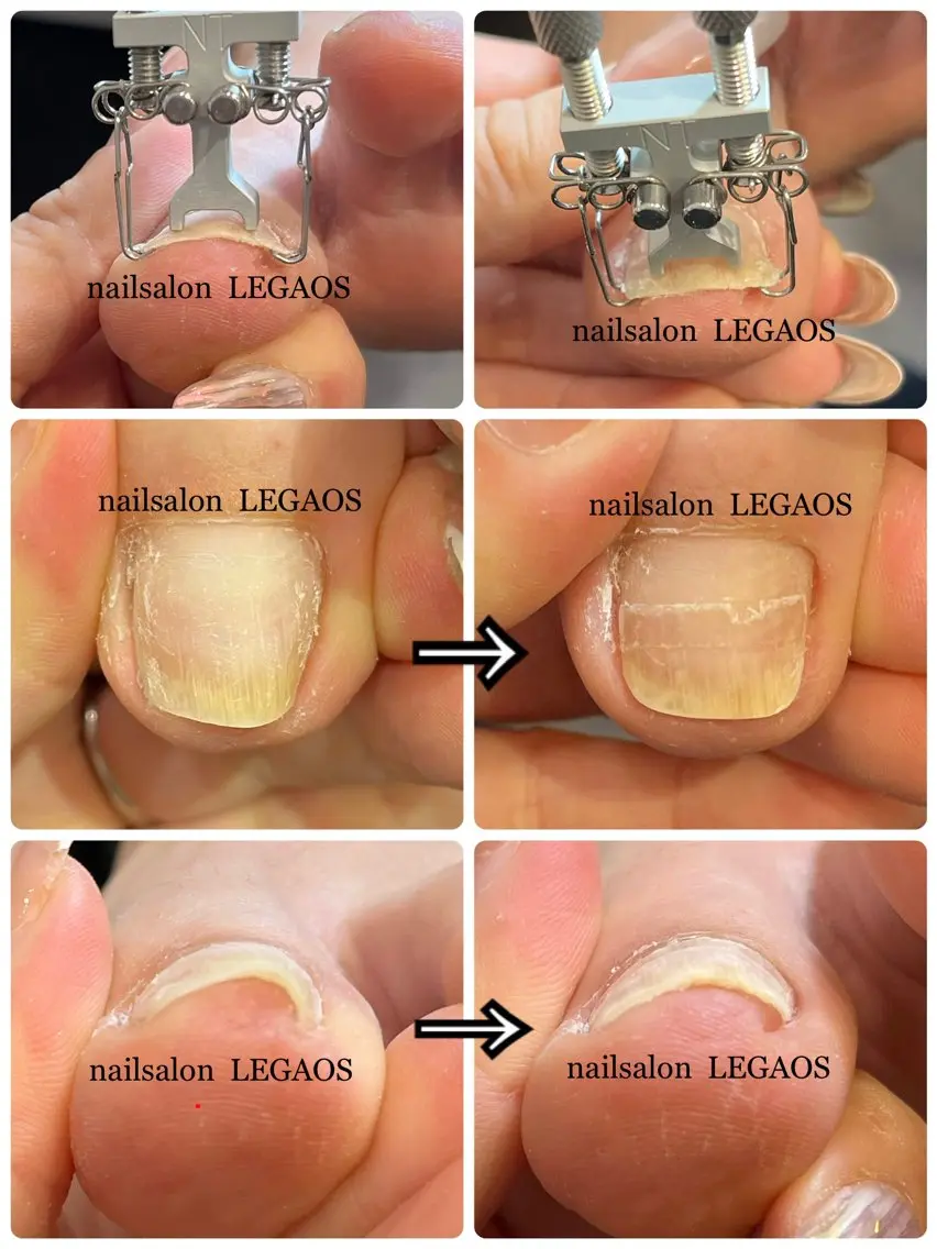 フット巻き爪ケア(両足親指)+全指ネイルケアの写真