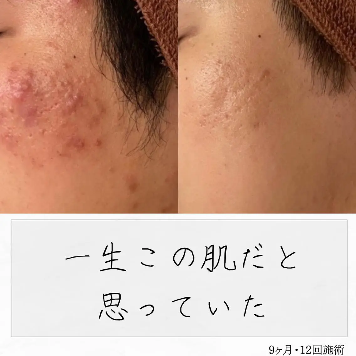 ニキビ経験者が施術 する専門サロン🌻のエステ・リラクイメージ