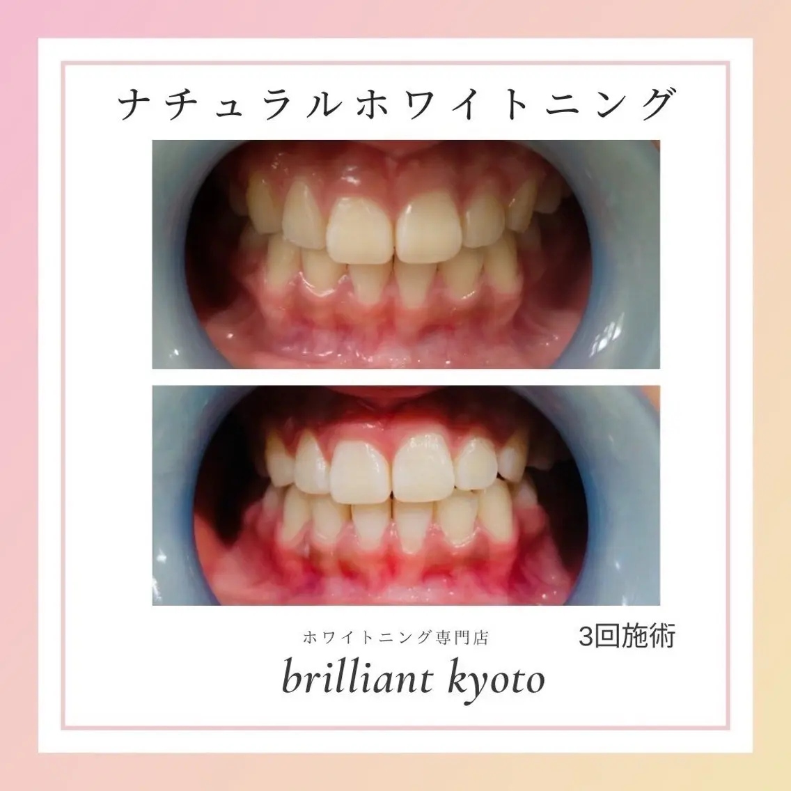 ナチュラルセルフホワイトニングの写真