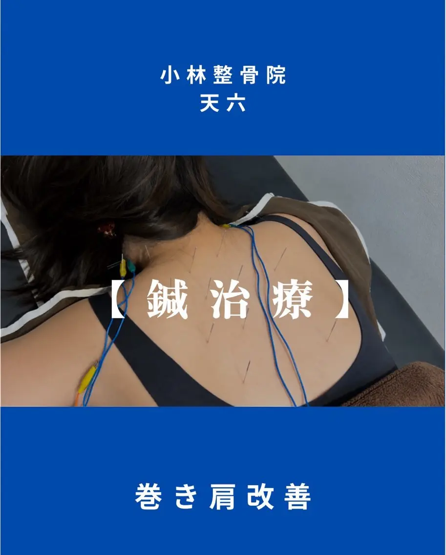 🍀鍼施術1400円体験🍀先着10名様限定価格✨️の写真
