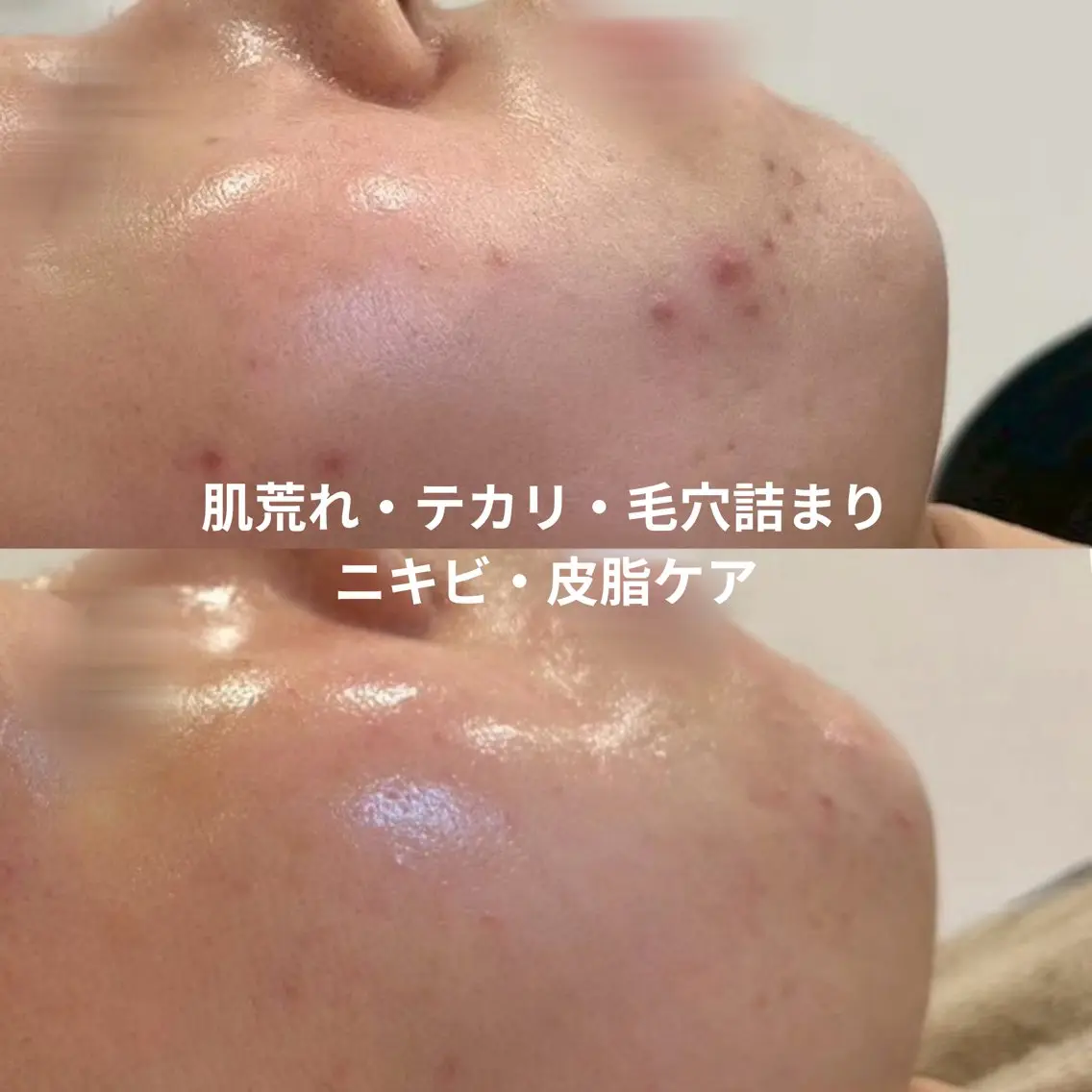 【初回】ニキビ・皮脂ケア🌿繰り返す肌荒れ・テカリ・毛穴詰まりにの写真