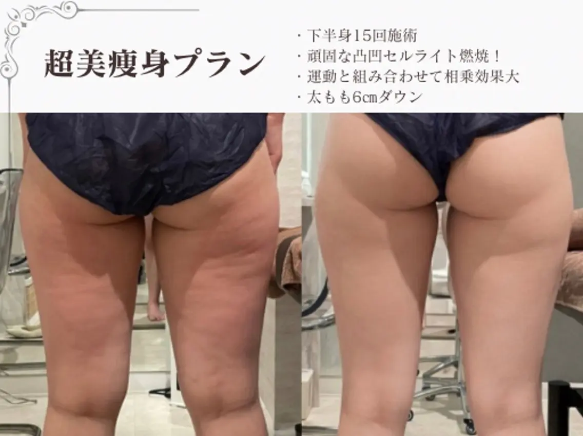 【人気No.1】骨盤矯正付き 選べる半身痩身|進化型最新ハイパーナイフEX2+ハイパーシェイプ+強圧リンパの写真