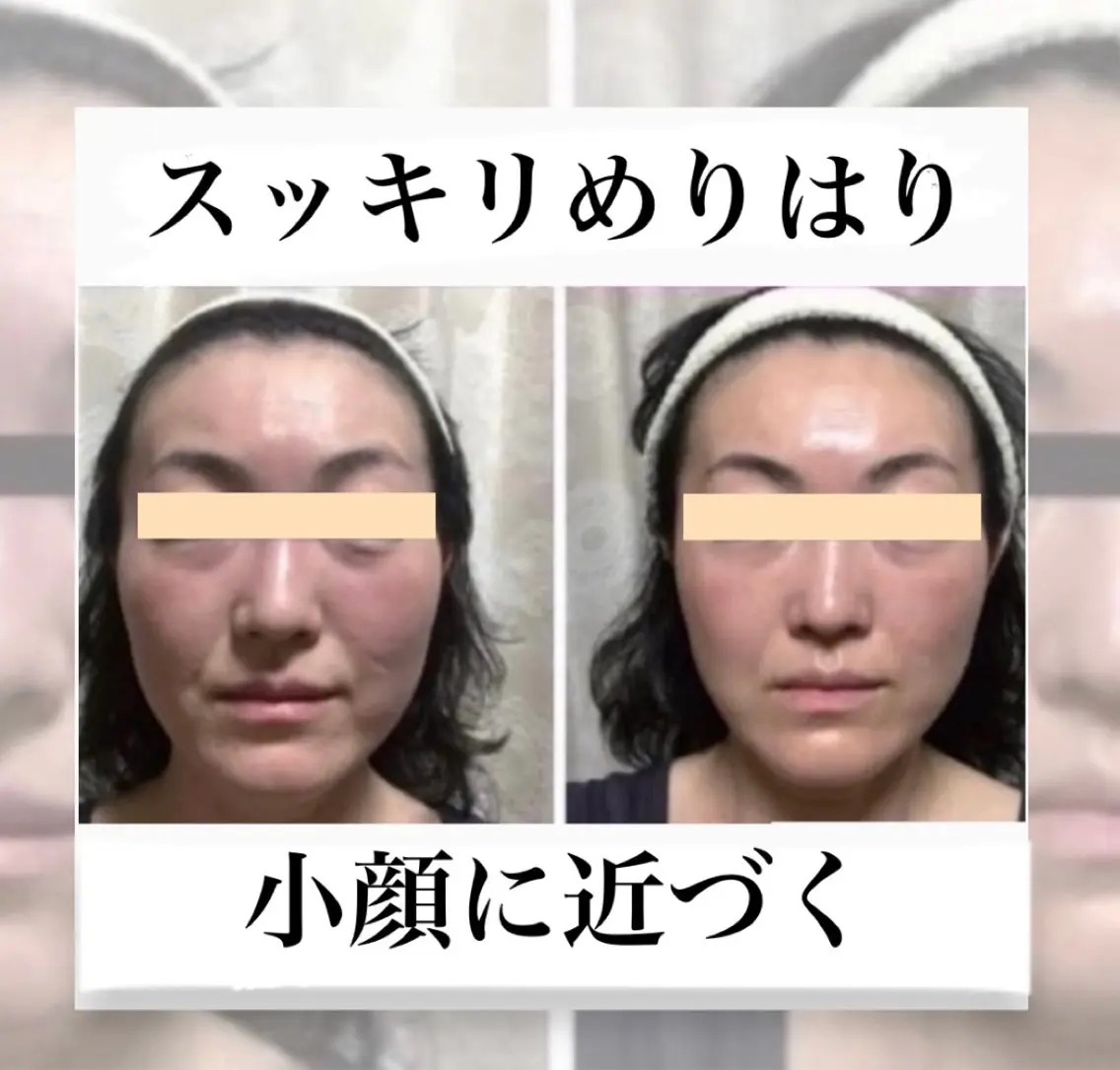 【リフトアップ】肌質改善フェイシャル＋高濃度美容成分の写真