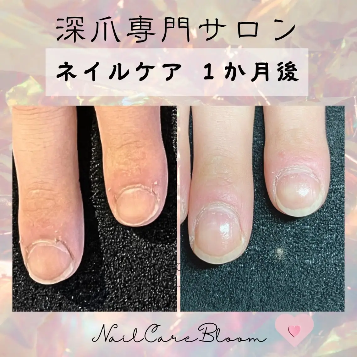 ネイル 深爪専門nail care bloomのネイルデザイン