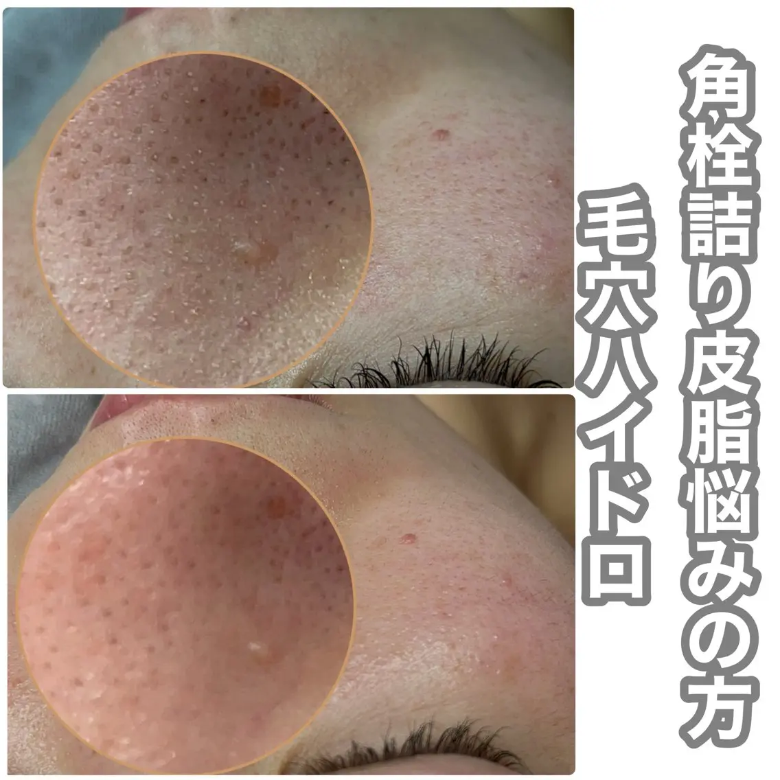 エステ REVI取扱・肌悩み 毛穴Chalonのエステ・リラクイメージ