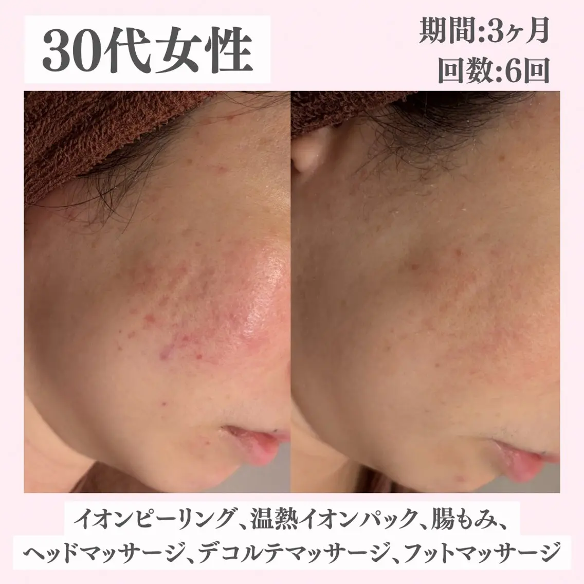 エステ リラク ニキビ・肌質改善専門 ♡人生が変わるサロンのエステ・リラクイメージ