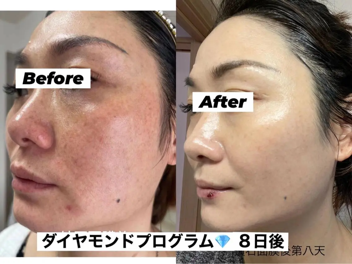 ダイヤモンドプログラムの写真