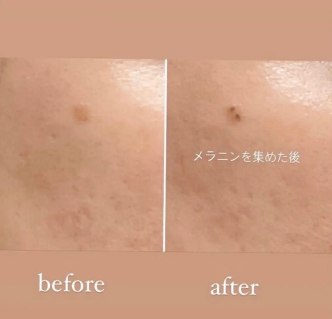 【スポットケア●○】Othelloスポットケア●○10分当て放題 ¥3,980の写真
