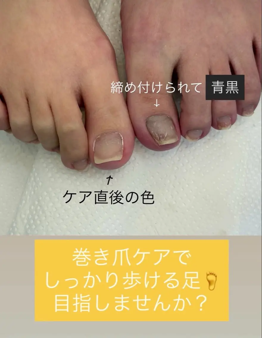 🦶巻き爪補正 1本¥2,500の写真