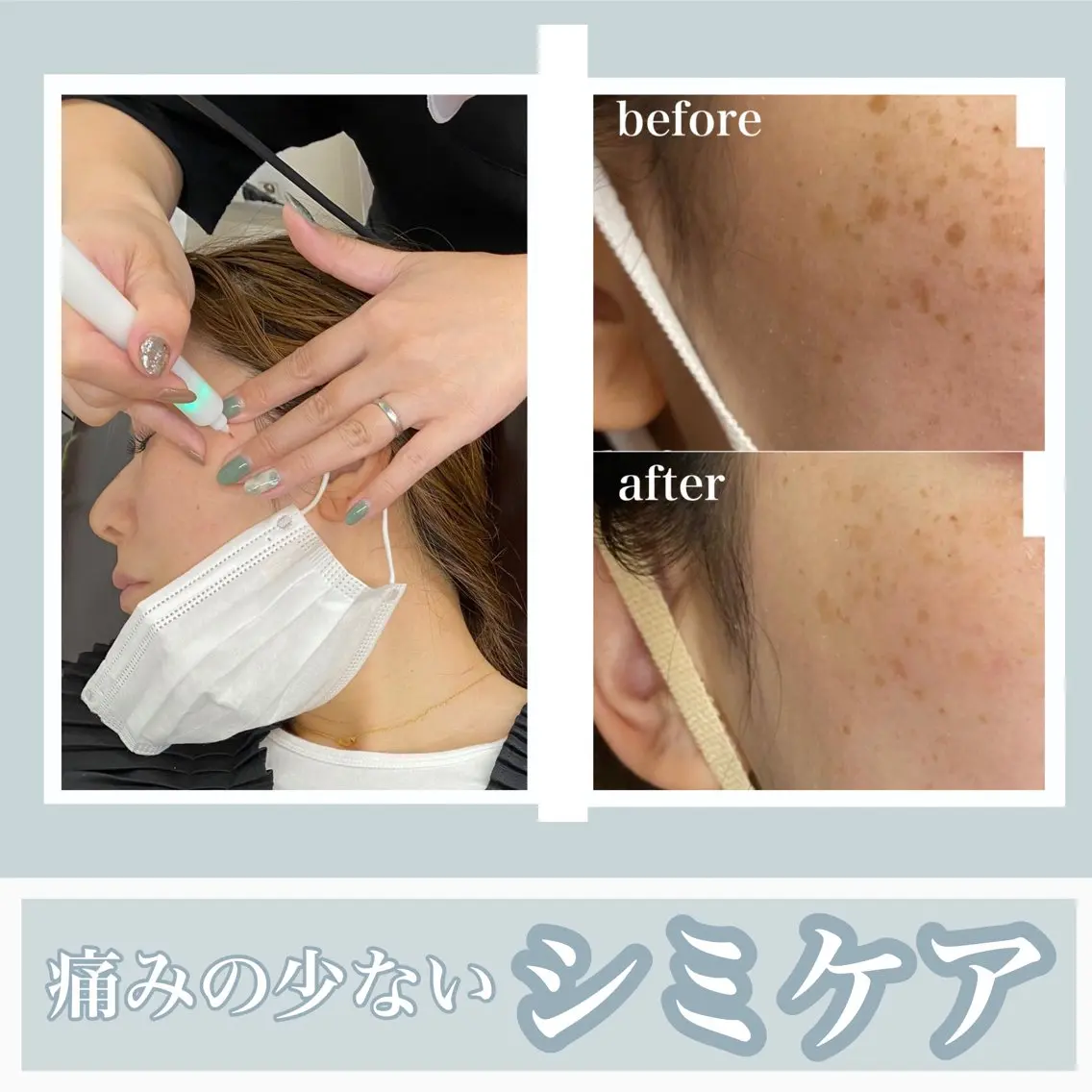 パリジェンヌ&シミケア（10ショット）の写真