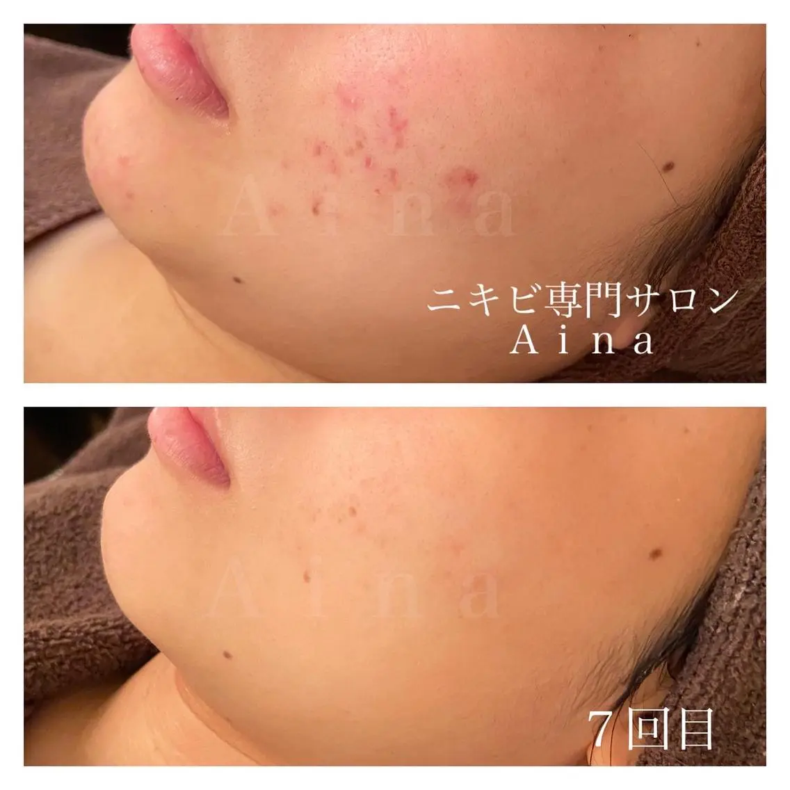 セミロング パーマ ヘアアレンジ メンズ キッズ ネイル マツエク・マツパ ニキビ跡専門サロン Ainaのエステ・リラクイメージ