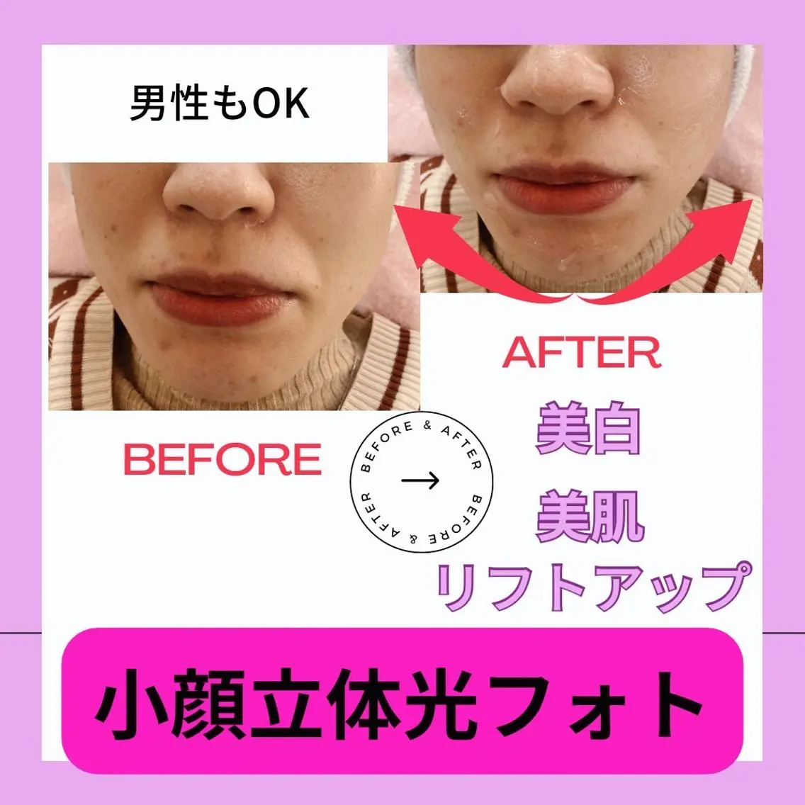 モニター価格★美肌★美白!光フォト➕美容パックつき!たるみ予防に!リフトアップ!再来店割引きありの写真