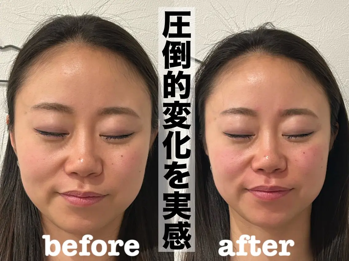 【目元・フェイスライン集中】美容鍼+電気パルス+小顔矯正の写真