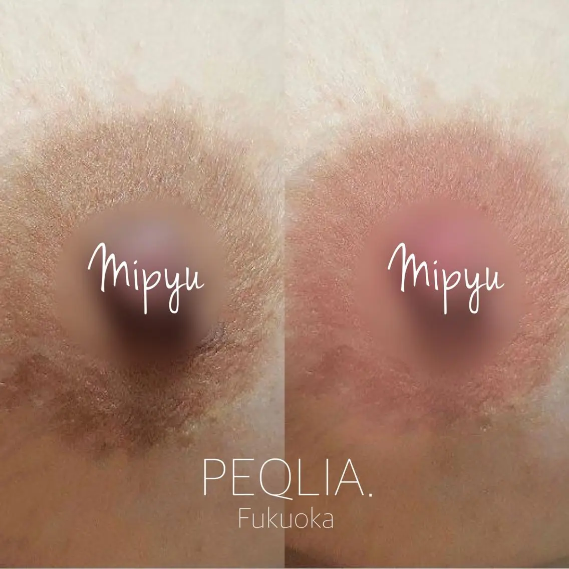 【最新メラニンケア/Mipyu】乳輪・乳頭/アフタークリーム1ヶ月分付の写真