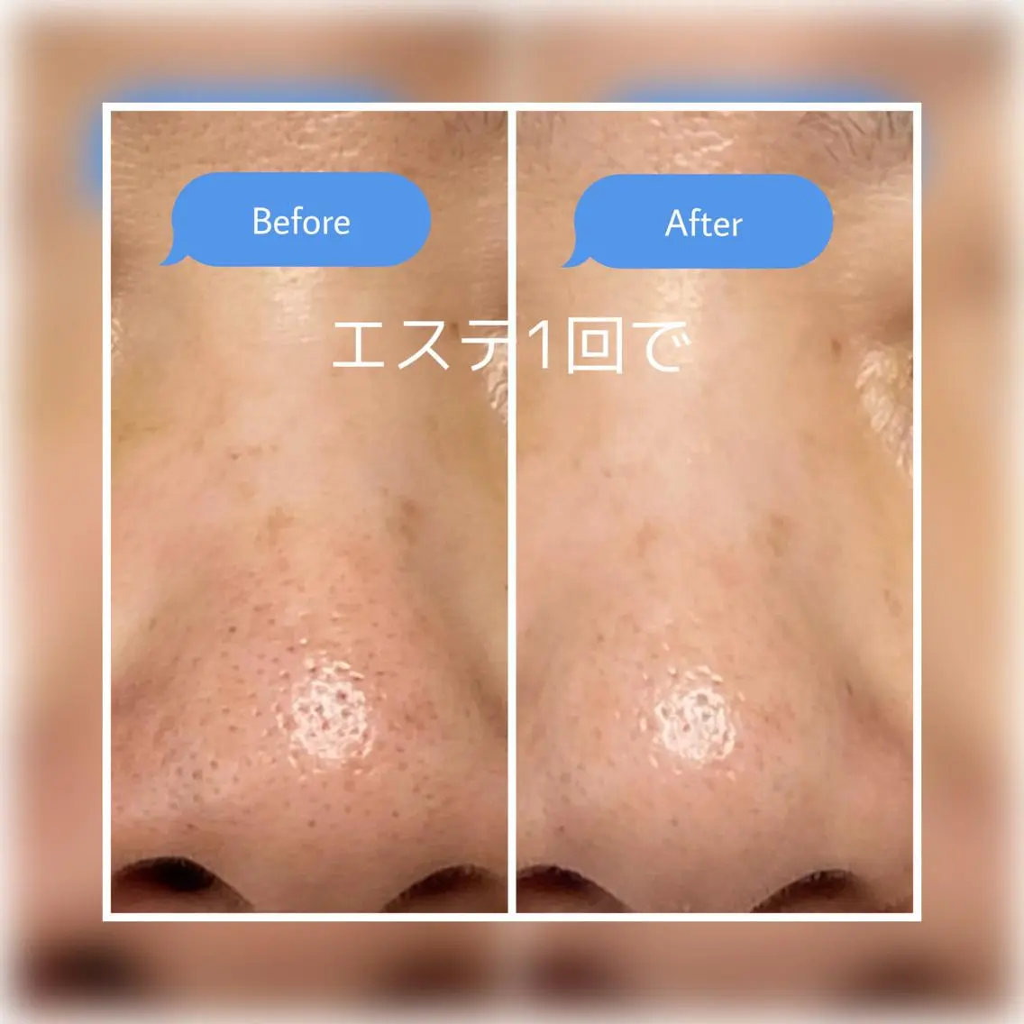 毛穴汚れスッキリコースの写真