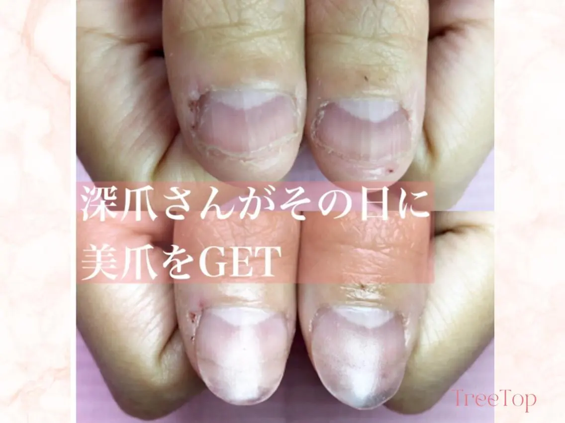 【メンズ】深爪・自爪育長さ出し(クリア)カラー追加¥1100の写真