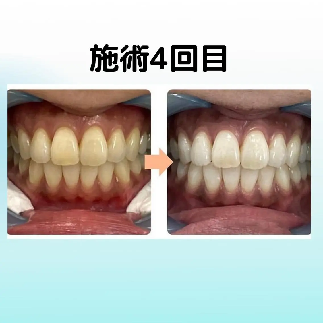 その他 ホワイトニング シャトンのその他イメージ