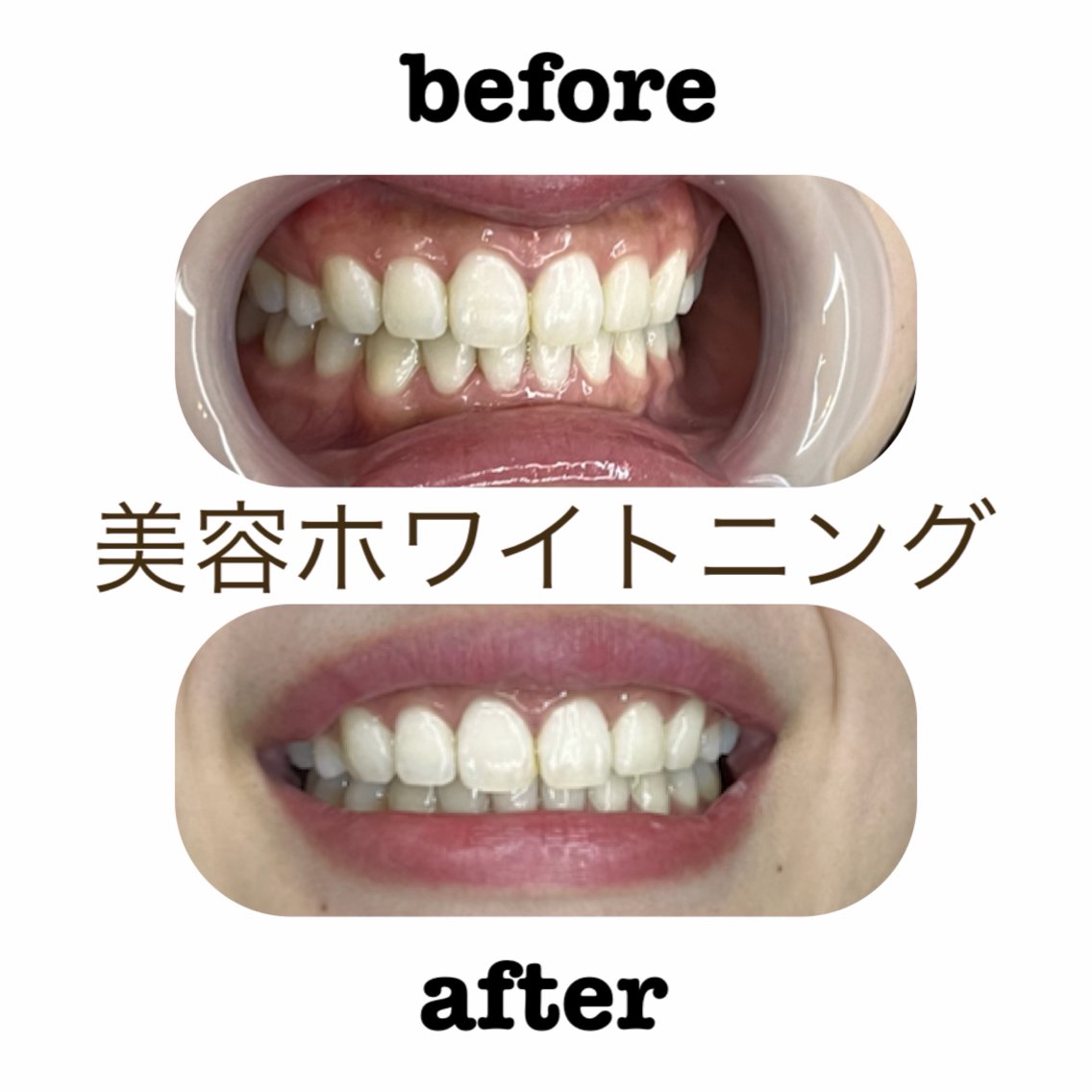セルフホワイトニング +1WHITE🌈のエステ・リラクイメージ
