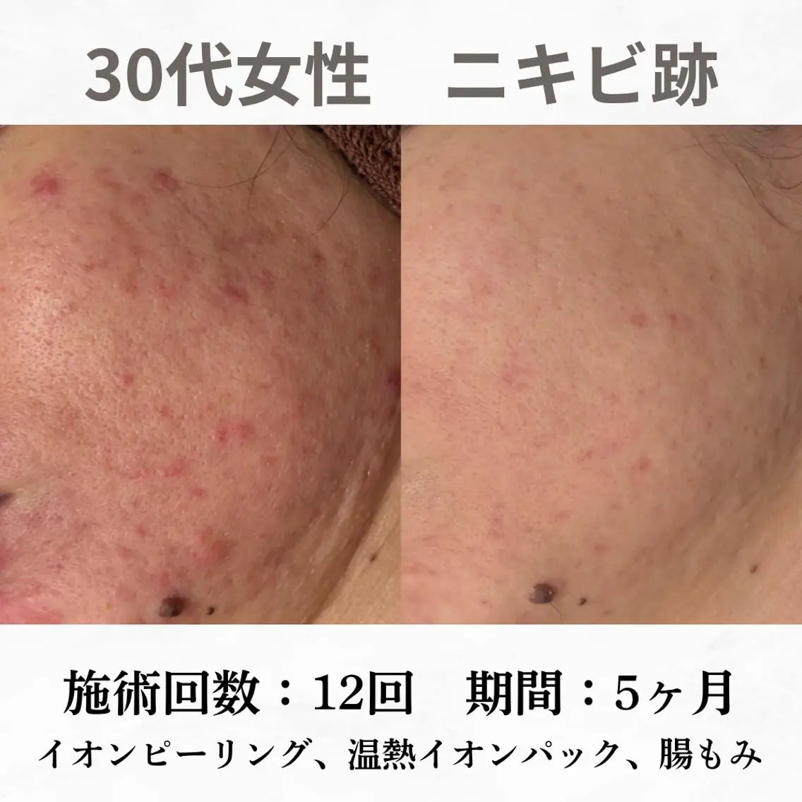 重度ニキビ専門🌷 ダウンタイムなしのエステ・リラクイメージ
