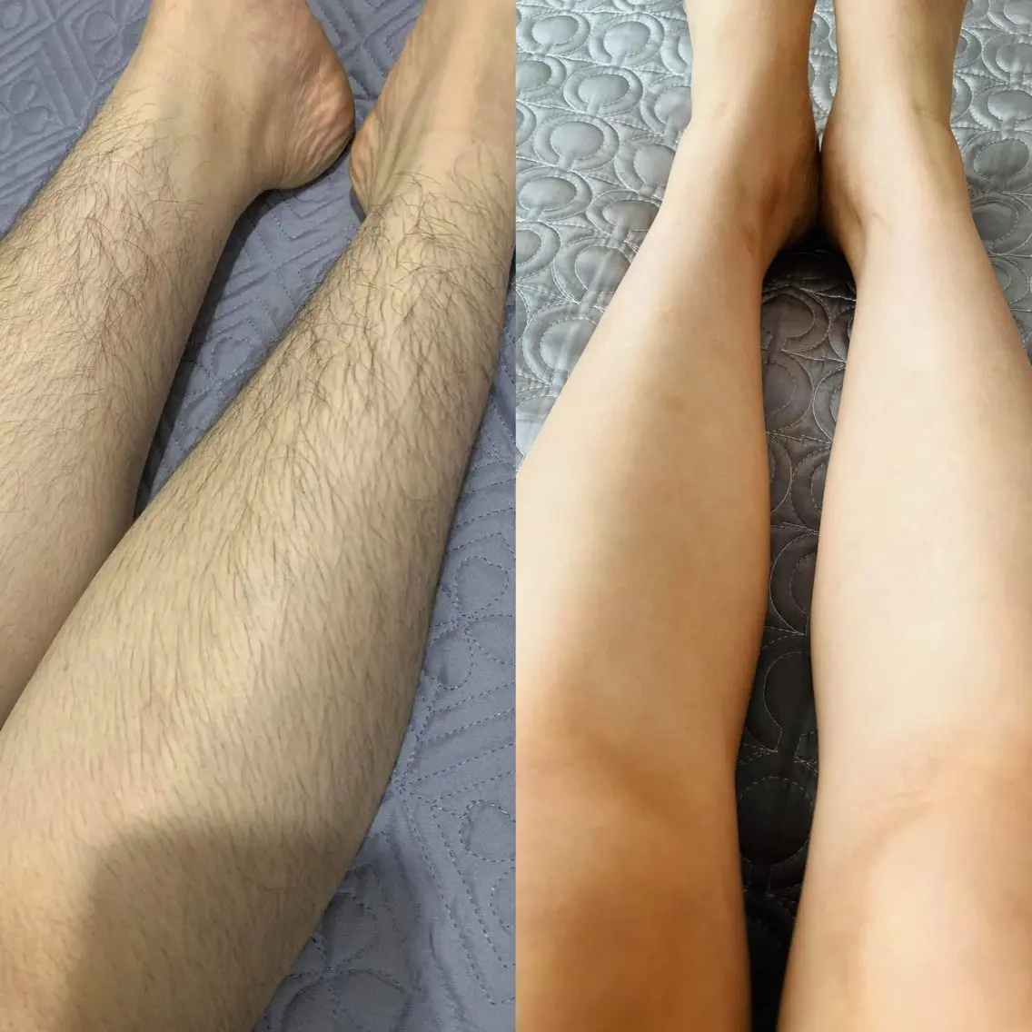 あし脱毛の写真